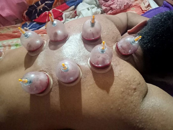 Hijama